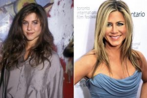 Известные люди до и после пластики: шокирующие изменения внешности